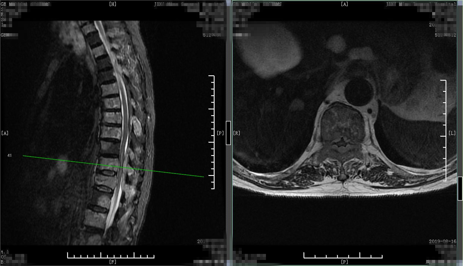 老年人腰腿痛不要忽视,中老年人腰背部酸痛