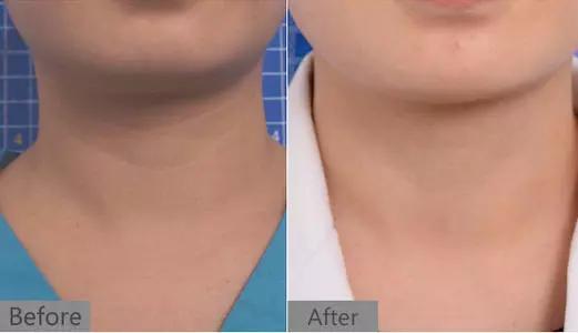 去脖子黑色素颈纹的最快方法,老年人脖子上的颈纹怎么遮挡