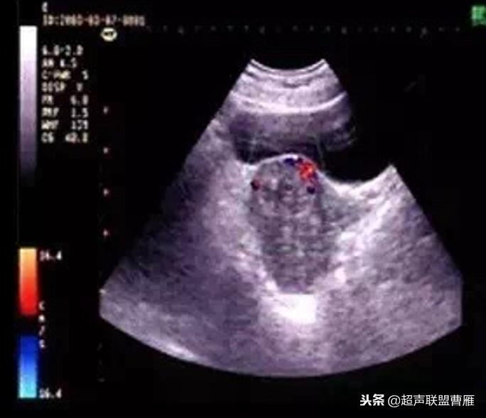 剖宫产疤痕妊娠几率,剖宫产疤痕妊娠及其护理