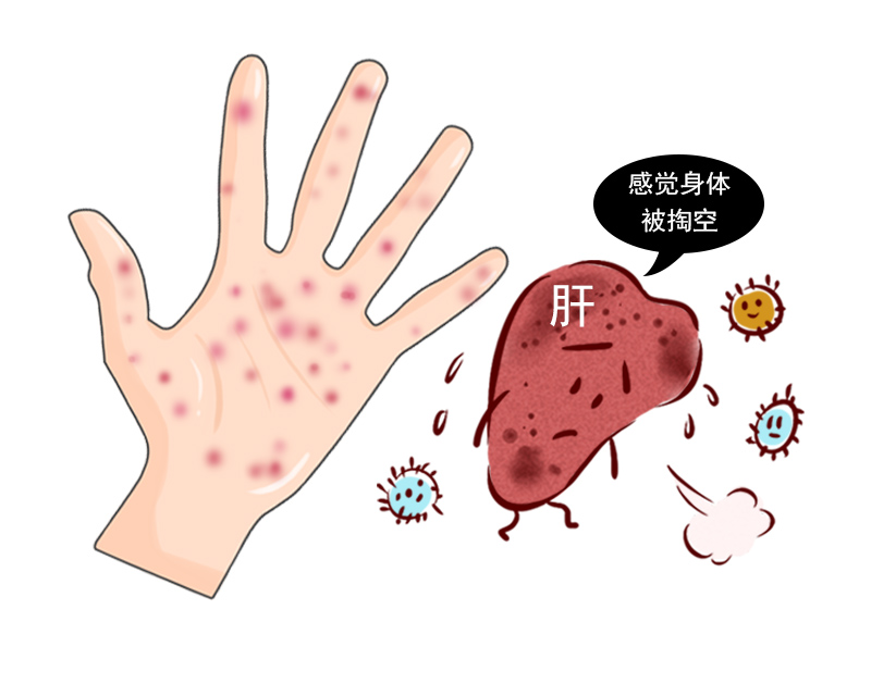 怎么判断痣是癌变还是普通痣,皮肤上长红痣要当心是肝病的征兆