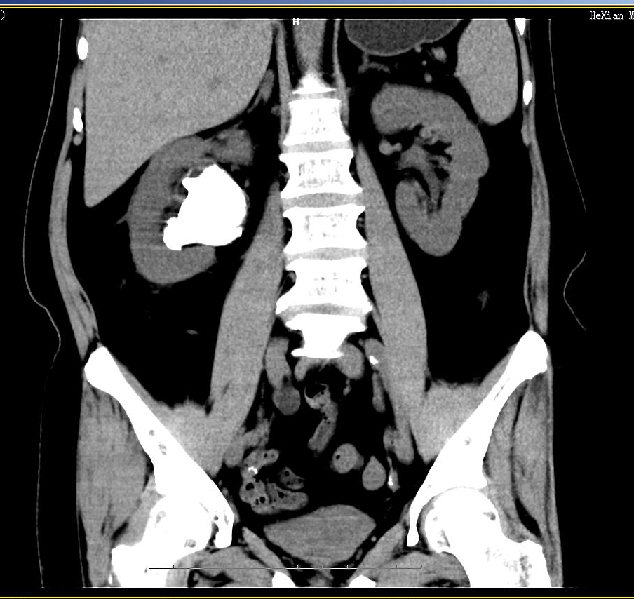 发现尿路结石不用慌!科学方法告诉你怎么吃?