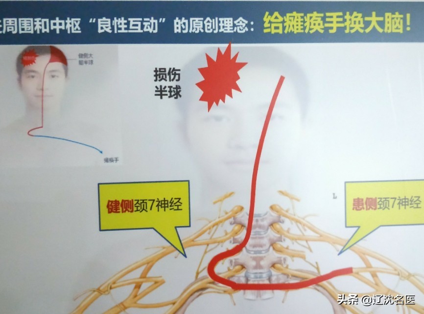 沈阳医大二院手足外科专家,沈阳现代医院治疗偏瘫