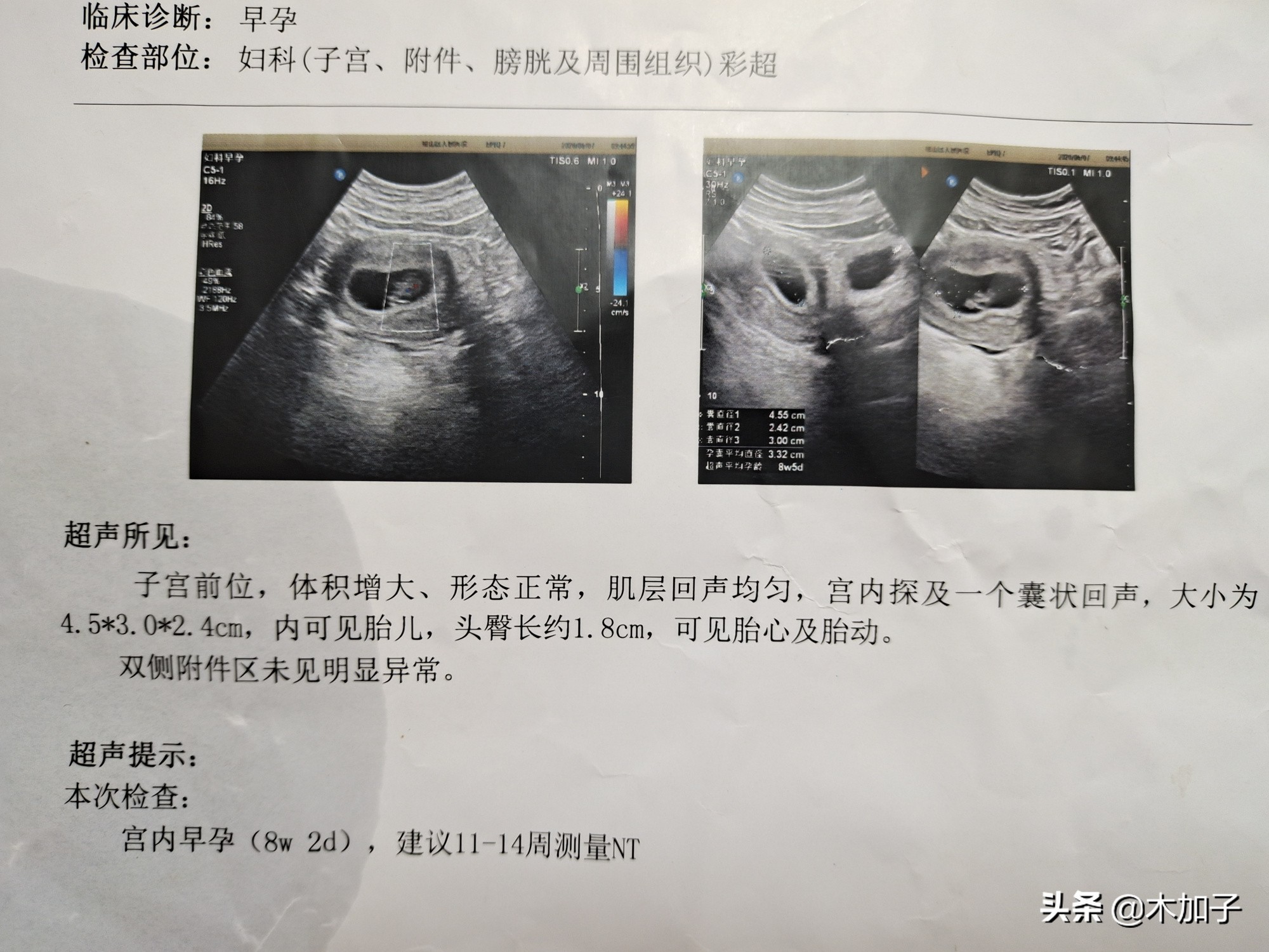 产检nt秒过怎么办,第一次产检b超nt不顺利