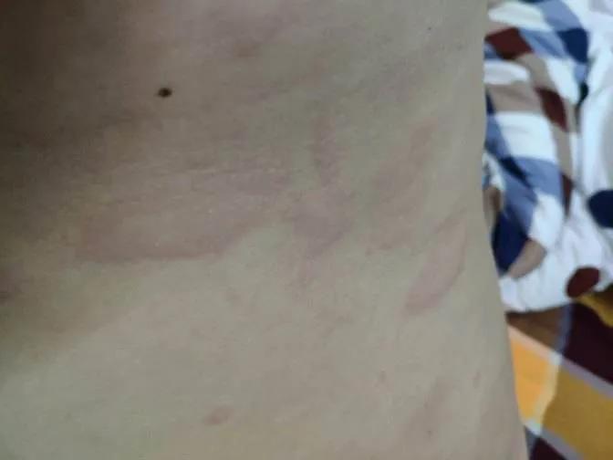 儿童荨麻疹反复发作三招教你搞定,小孩麻疹不治疗自己会好吗