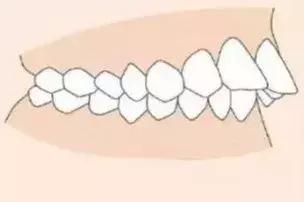 你需要去做个牙齿矫正是什么意思,为什么要做牙齿正畸