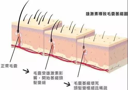 脱发毛囊坏死是怎么回事,脱发厉害的毛囊一般存在什么问题