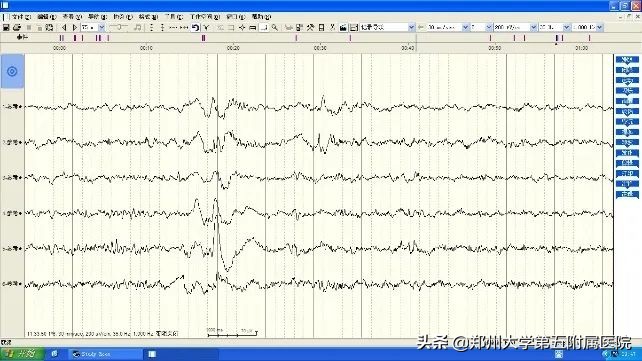 最先进有效的癫痫手术,癫痫手术是否能一次治愈