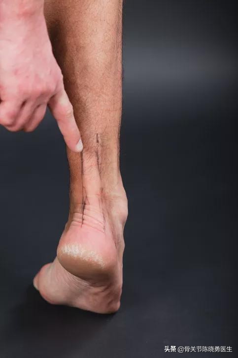 小腿感觉被人踢了跟腱断裂,踢一脚跟腱断裂