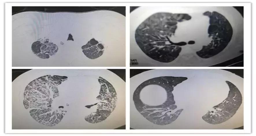 呼吸困难为主要症状的住院大病历,病人出现呼吸困难症状