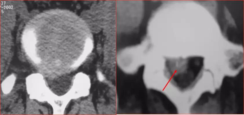 颈椎腰椎疾病ct及mri诊断,腰椎ct可以发现肠部病变吗
