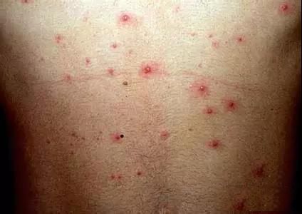 小孩皮疹湿疹水痘有什么区别,幼儿急疹出的疹子是水痘吗