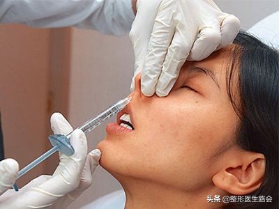 隆鼻膨体好还是玻尿酸好,硅胶膨体和玻尿酸隆鼻