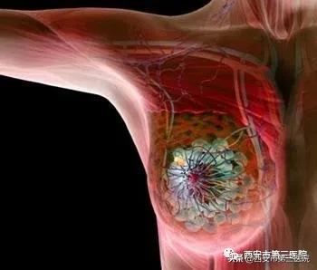 乳腺癌治疗史的不断演进,中医讲乳腺癌的真实故事