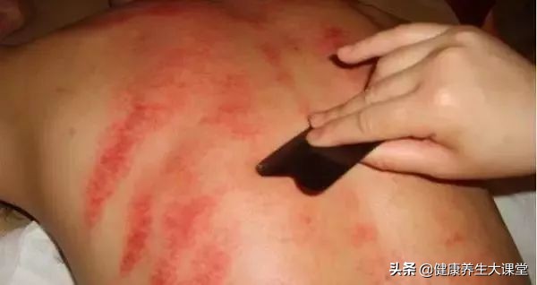 刮痧过后的印是叫什么,刮痧后痧印发黄