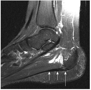 早起脚跟痛脚底板痛肿胀怎么回事,早起脚底板疼走一会又不疼了