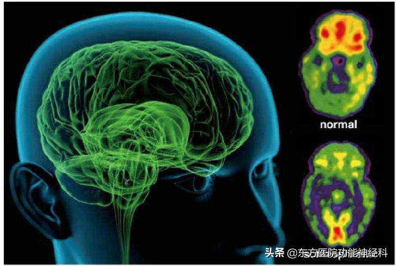 精神分裂症幻听最好的治疗方法,精神分裂症患者夸大妄想怎么解决
