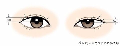 先天性眼睛上睑下垂严重怎么治疗,先天性上睑下垂恢复