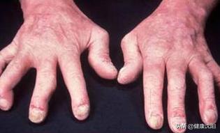 健康科普知识骨关节炎的概述,健康科普老年性骨性关节炎