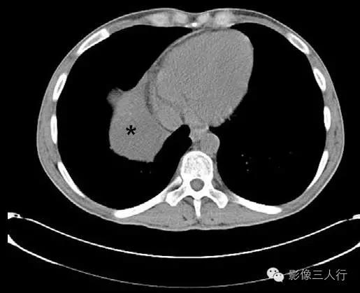 纵隔囊肿影像学表现,纵隔囊肿心包囊肿
