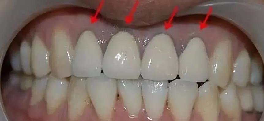 做了烤瓷牙后悔了有补救办法吗,做了烤瓷牙后悔了怎么补救