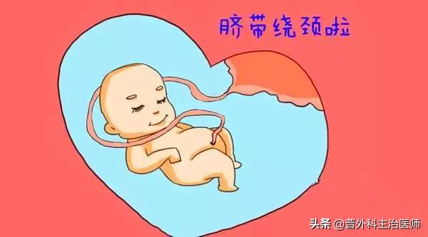 胎死宫内的刽子手-------脐带缠绕