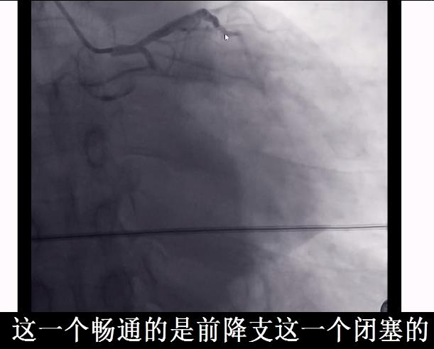 胸闷胸疼心脏彩超心电图ct没问题,胸疼但是心电图正常