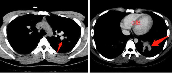 霉菌吸入肺部的危害,霉菌不小心吸到肺里了咋办