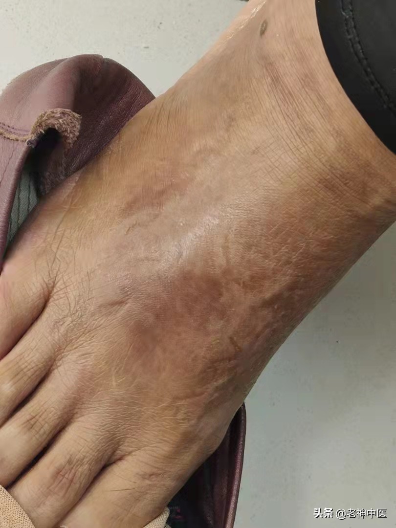 慢性阑尾炎大黄牡丹汤医案,大黄牡丹汤治疗阑尾炎原方