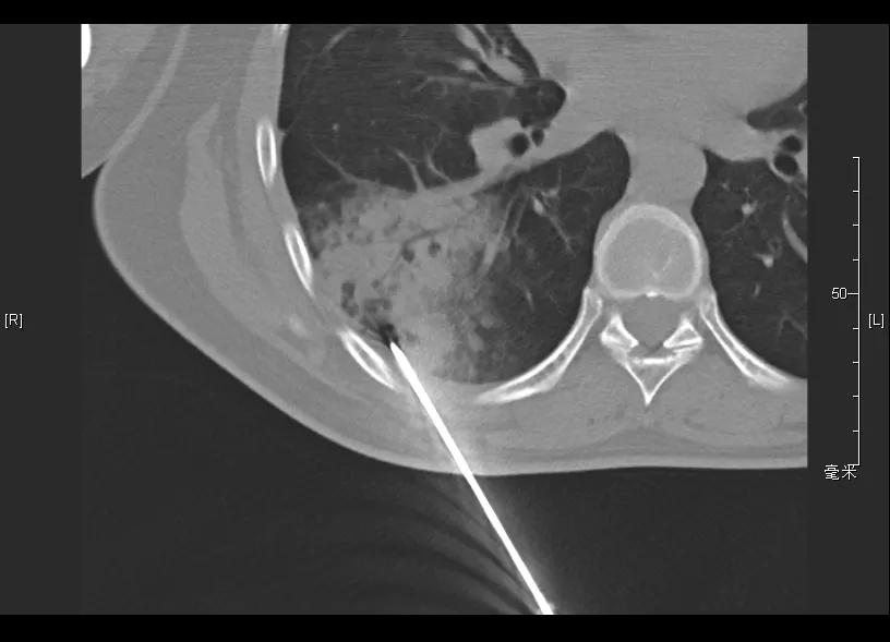 特发性肺炎一直用激素治疗,机化性肺炎住院治疗使用什么药物