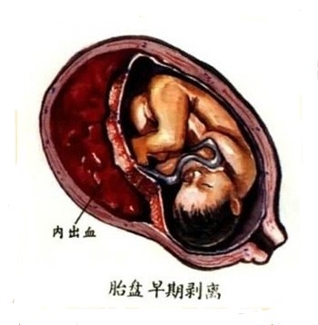 孕期出血意味着流产吗,孕期突然大量出血是不是流产了