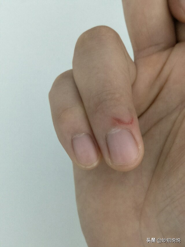 不知道被什么划伤的伤口怎么处理,被划破如何快速愈合