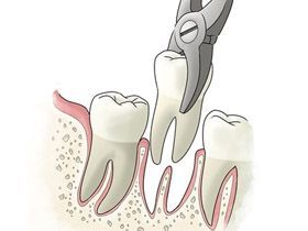 牙疼引起神经疼怎么治疗,牙疼引起牙齿疼痛怎么办