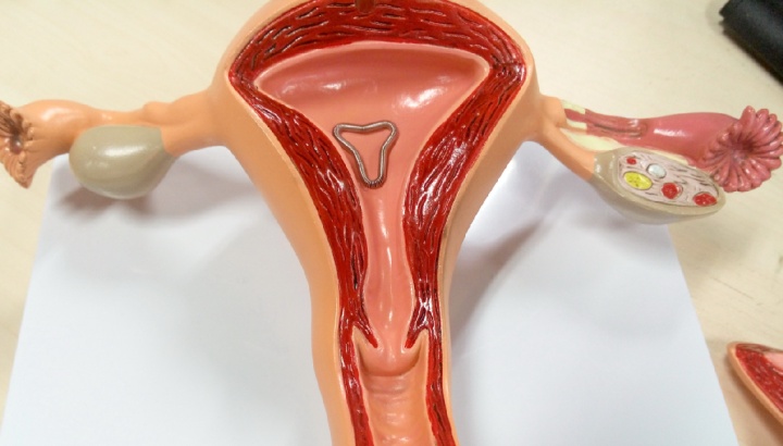 宫内节育器和节育环有什么区别,宫内节育器避孕环