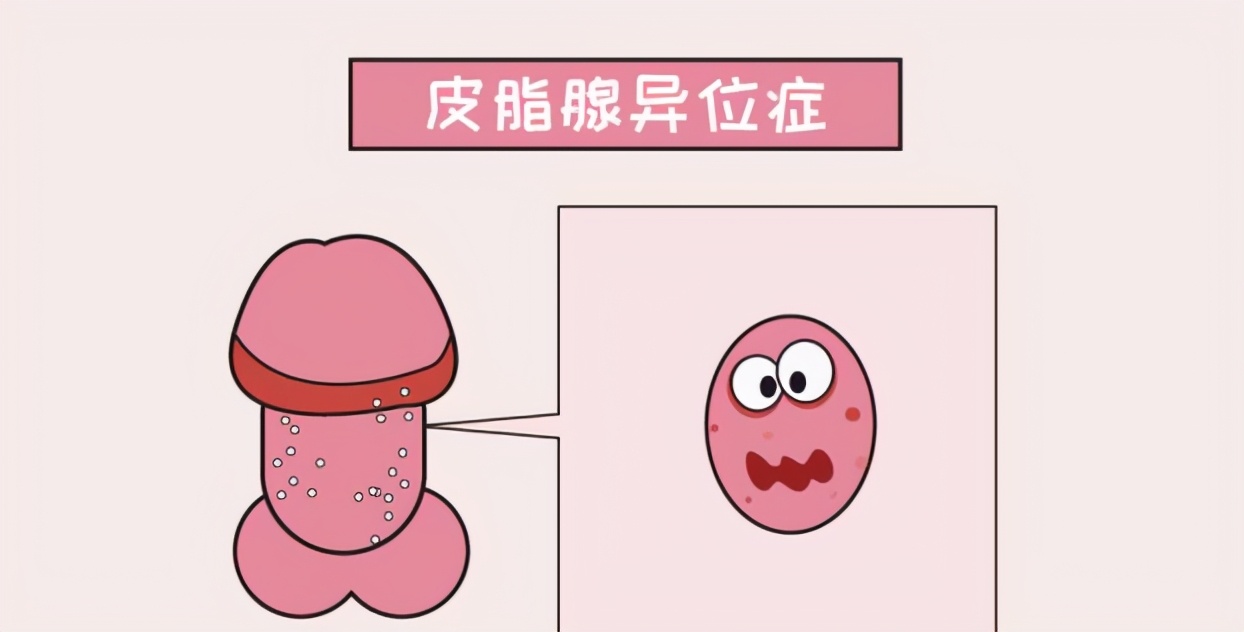 尖锐性湿疣应与什么疾病鉴别,尖锐性湿疣与其它病的鉴别