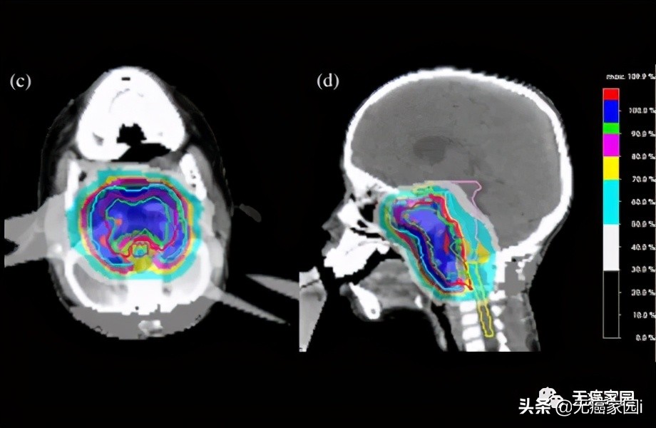 质子重离子治疗能治愈晚期癌症吗,质子治疗肿瘤最佳手段
