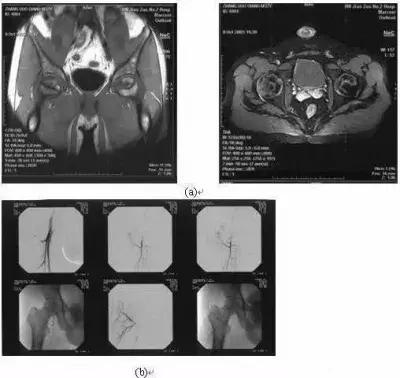 股骨头坏死早期介入和干预,股骨头坏死早期介入治疗
