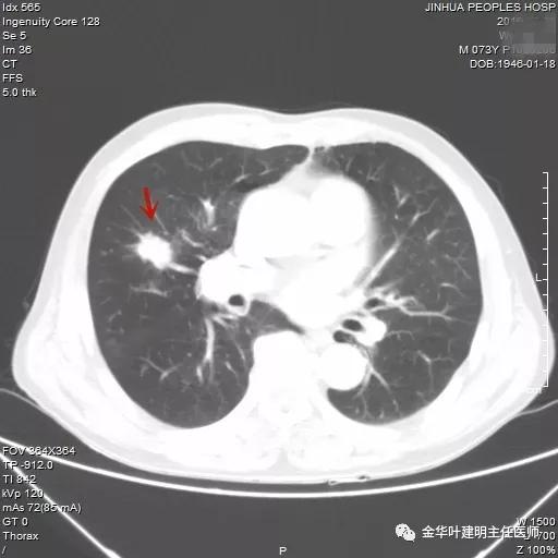 能不能手术,极重度混合性通气功能障碍能治吗