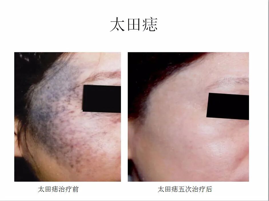 超皮秒华美,超皮秒专场直播