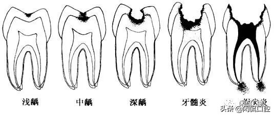 牙齿从中间蛀掉如何治疗,4岁牙齿被蛀空了怎么办