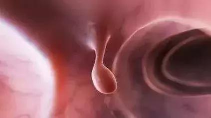 结节息肉囊肿增生哪个是癌症先兆,乙状结肠增生性的息肉会癌变吗