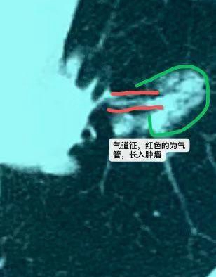 考虑肺癌伴淋巴结转移是肺癌吗,65岁肺癌晚期转移淋巴能活多久