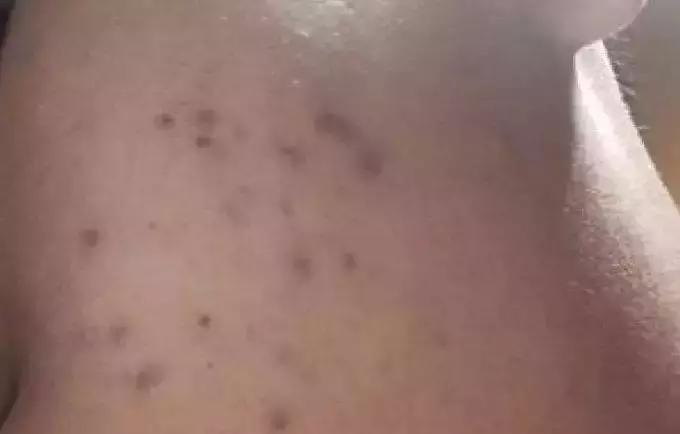 痘印反复冒痘怎么消除男生,痘印痘痘反反复复怎么办