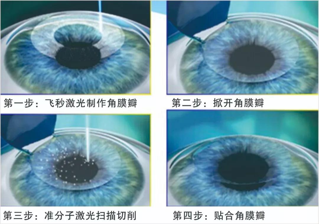 参军入伍、毕业就职，你的眼睛视力达标了吗？5月23（周六）特邀专家手术需要摘镜的伙伴提前预约啦！