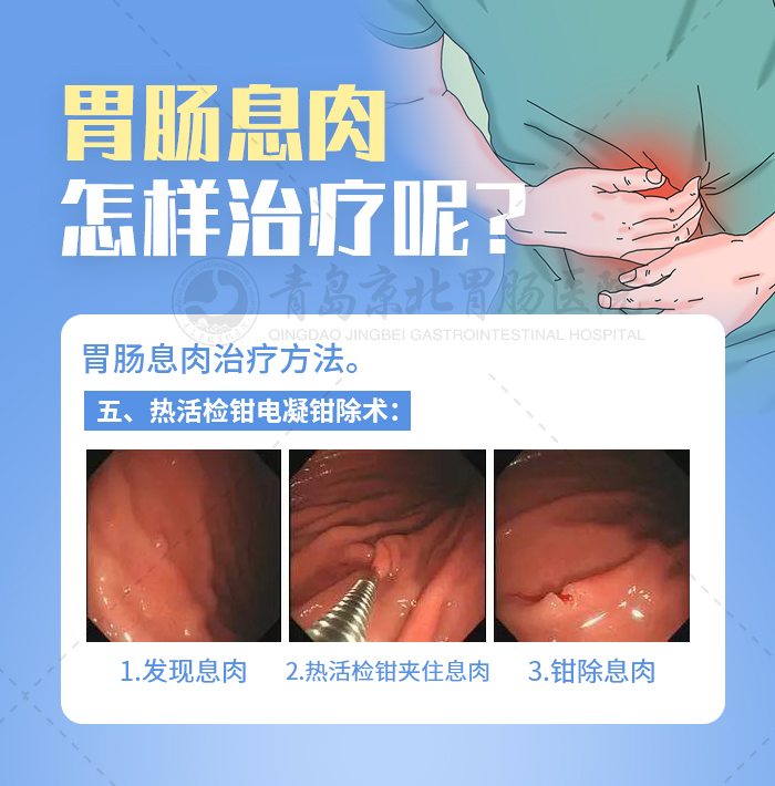 胃肠镜发现有息肉严重吗,肠镜多大息肉可内镜下切除