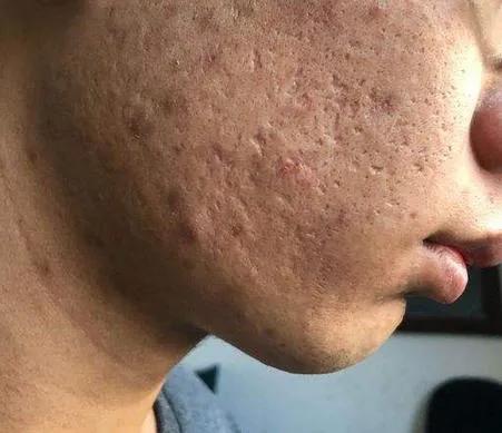 疱疹后遗症怎么治,疮疤留下的黑印怎么消除