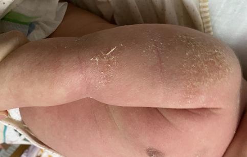 湿疹婴儿新冠全身起疹子,婴儿新冠后湿疹加重的原因