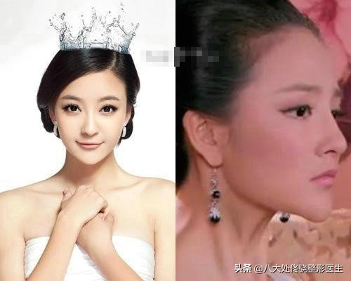 注射肉毒素脸部变化,肉毒素可以改变大小脸吗