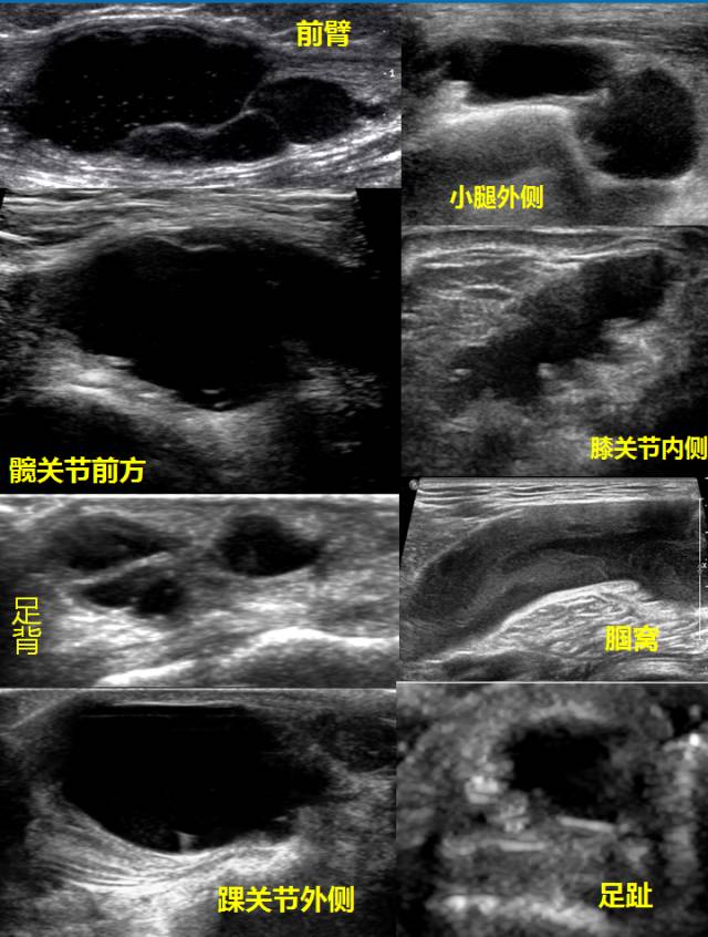 手腕出现小疙瘩越来越大,手腕突然长了一个小骨