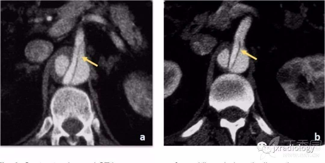 急性主动脉综合征报道,急性主动脉综合征症状