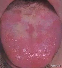 舌苔与疾病对照表详细,舌苔黑是什么疾病产生